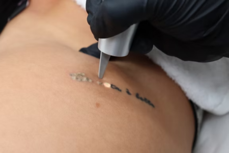 ‘Think before you ink – or remove’: Tattoo removal on the rise by 30% this year